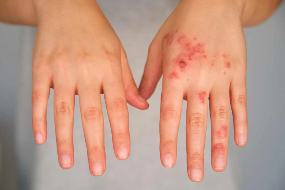 Impetigo sores on the hands