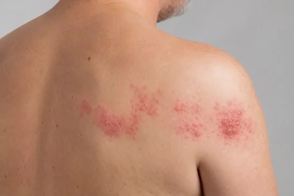 Shingles rash across the shoulder and back