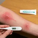 Infected insect bites on a forearm being checked with a thermometer